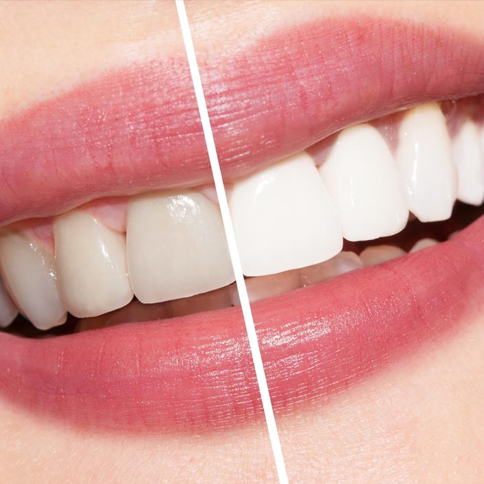 KöR Teeth Whitening