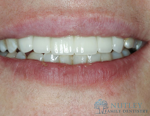 Smile Makeover with Composite