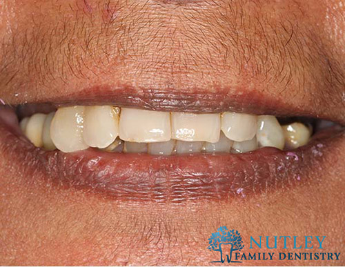 Smile Makeover with Composite
